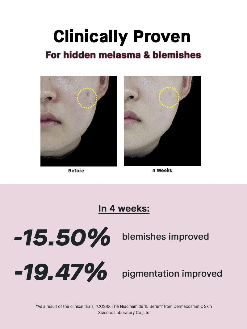 COSRX The Niacinamide 15 Serum results showing improvement in melasma and blemishes after 4 weeks treatment.