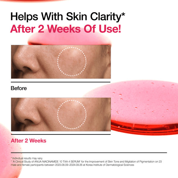 Before and after results showing skin clarity improvement using Anua Niacinamide 10 TXA 4 Serum after 2 weeks.