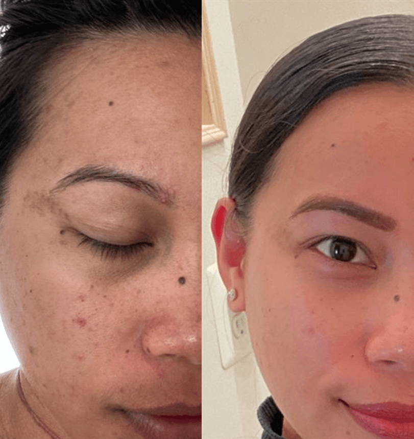 Before and after using Medicube Deep Vita C Ampoule, showcasing improvement in skin tone and brightness.