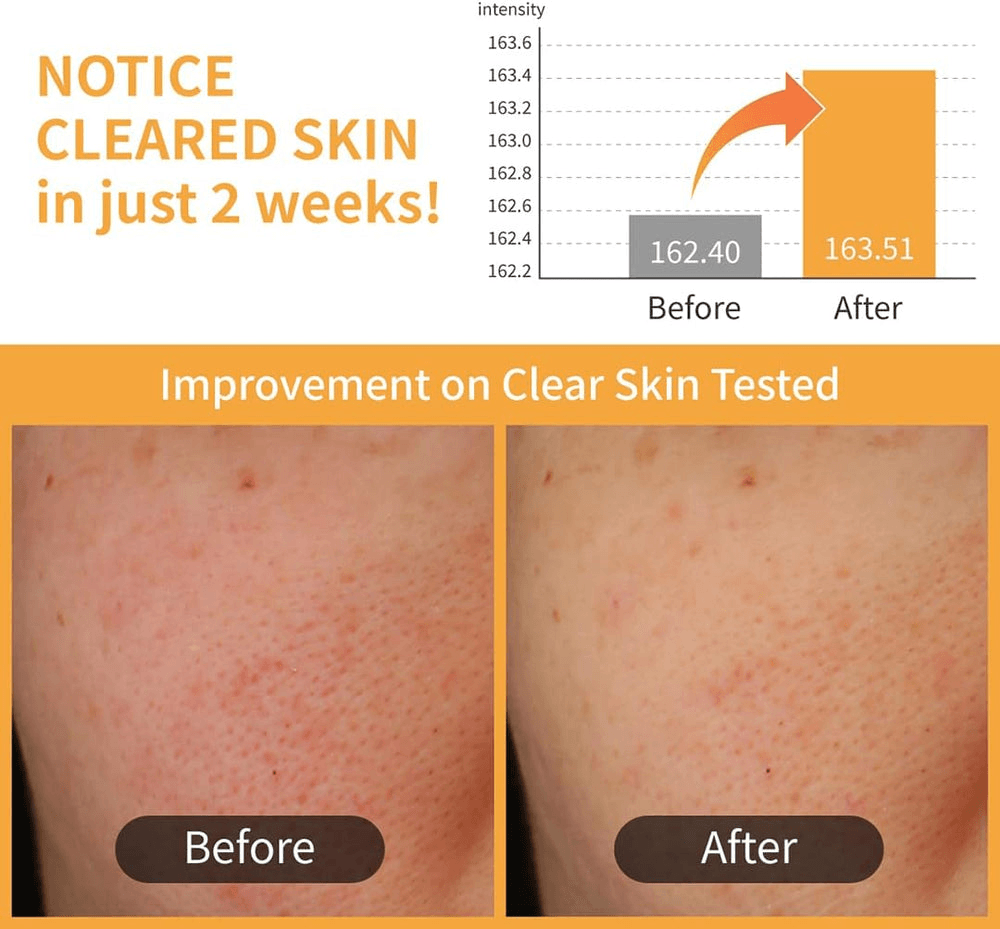 numbuzin No.3 Radiance Glowing Jumbo Essence Pads  Before and after comparison showing improvement in skin clarity with notice on cleared skin in just 2 weeks.
