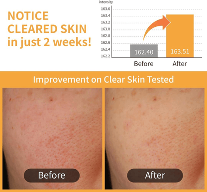 numbuzin No.3 Radiance Glowing Jumbo Essence Pads  Before and after comparison showing improvement in skin clarity with notice on cleared skin in just 2 weeks.