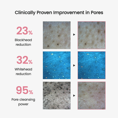 Biodance Collagen Cleansing Oil Clinically proven improvement in pores showing 23% blackhead reduction, 32% whitehead reduction, and 95% pore cleansing power.