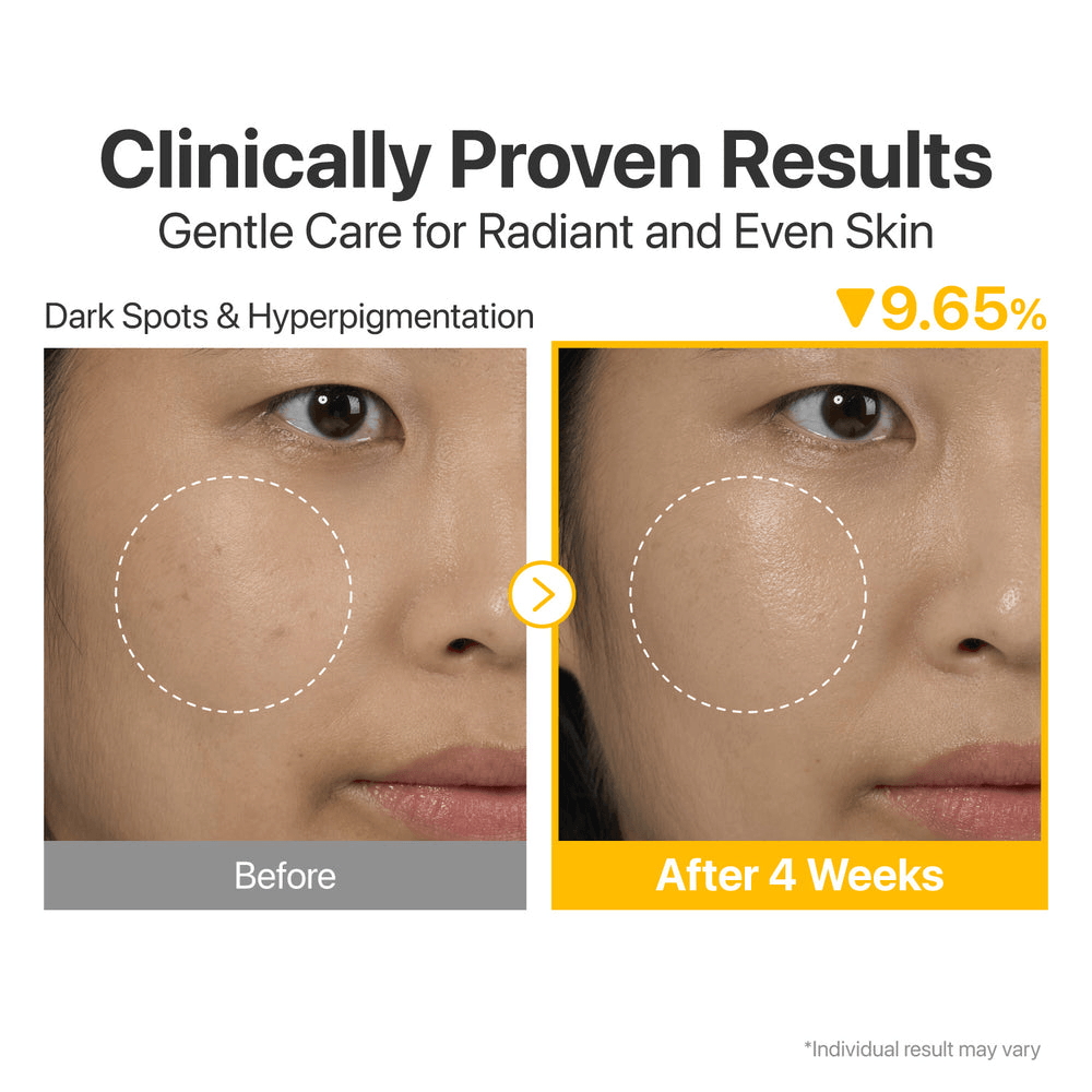 Before and after comparison showing results of numbuzin No.5 Glutathione Vitamin Concentrated Serum on dark spots.