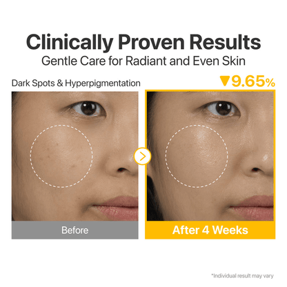 Before and after comparison showing results of numbuzin No.5 Glutathione Vitamin Concentrated Serum on dark spots.