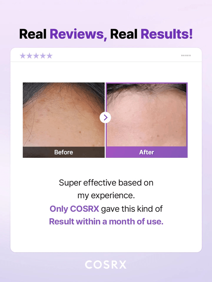 Before and after results using COSRX AHA/BHA Clarifying Treatment Toner for clearer skin and improved texture.