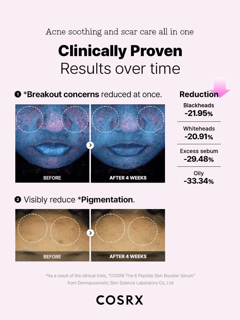 COSRX The 6 Peptide Skin Booster Serum before and after results showing reduced acne and pigmentation.