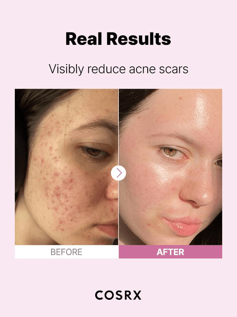 Before and after showing real results of COSRX The Niacinamide 15 Serum in visibly reducing acne scars.