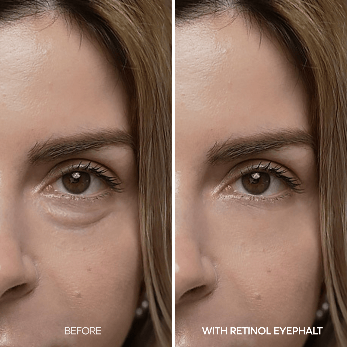 Image showing before and after results of using Dr. Melaxin Eyephalt Retinal Eyebag Cream for under-eye bags.