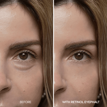 Image showing before and after results of using Dr. Melaxin Eyephalt Retinal Eyebag Cream for under-eye bags.