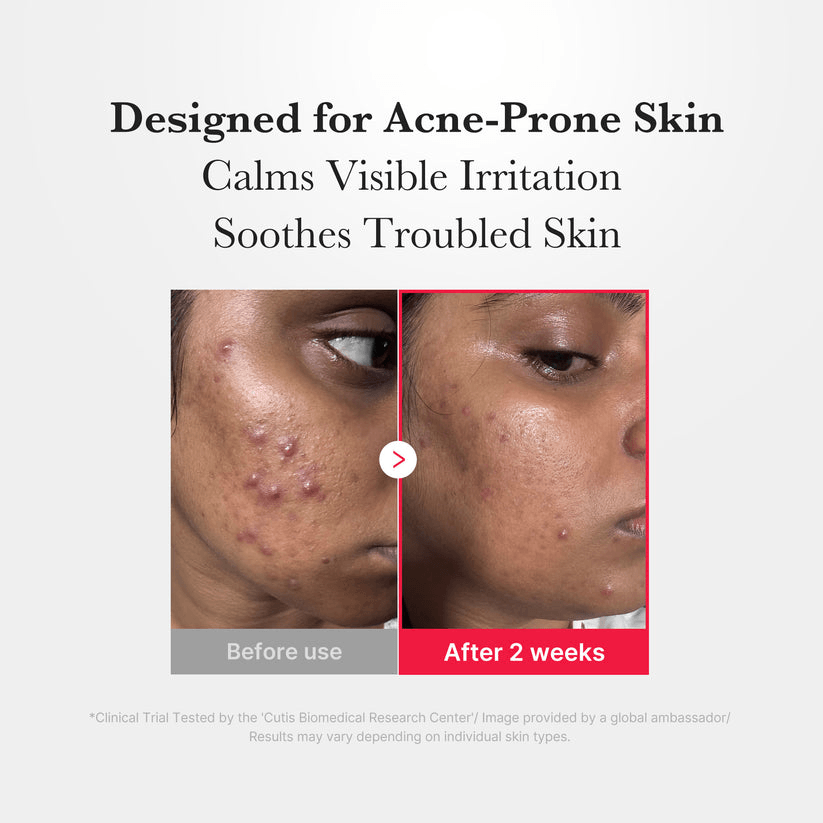 Before and after images of acne-prone skin showing improvement with Medicube Hypochlorous Acid Power Soothing Spray.