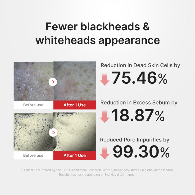 Before and after results of Medicube Hypochlorous Acid Rice Peel Shot showing fewer blackheads and whiteheads appearance.