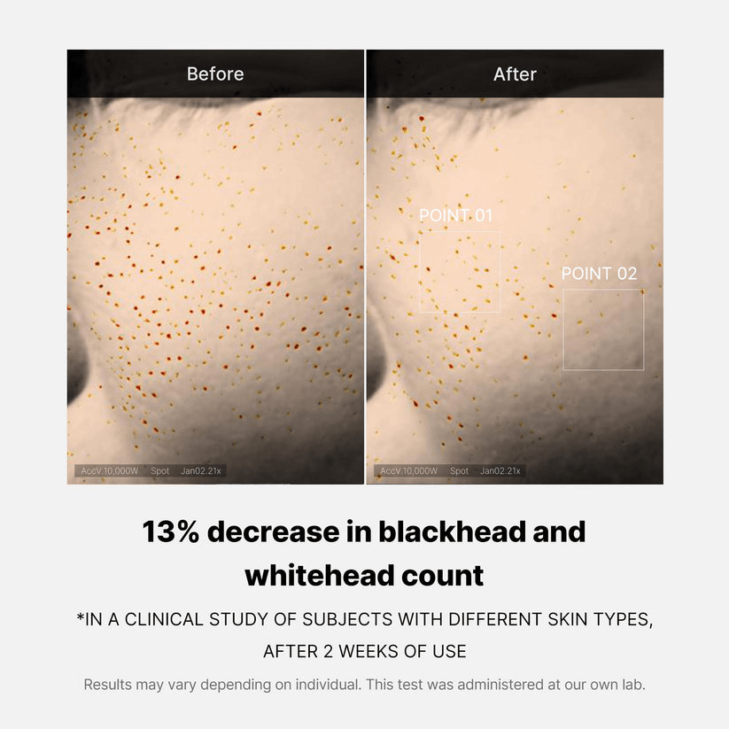 Before and after images showing 13% decrease in blackhead and whitehead count with Medicube Zero Pore One-day Serum.
