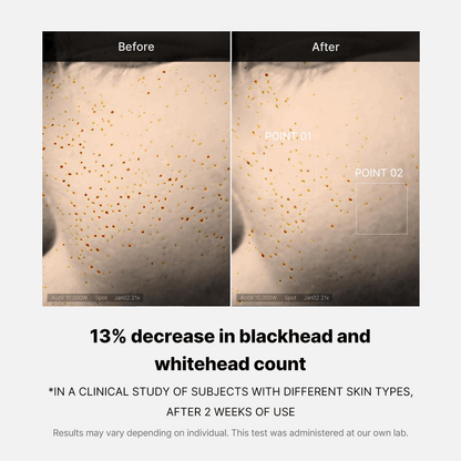 Before and after images showing 13% decrease in blackhead and whitehead count with Medicube Zero Pore One-day Serum.